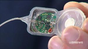 'Fitbit' for the brain alerts epilepsy sufferers to incoming seizures